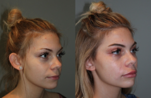Juvederm Lip Injections - 19 year old female immediately following bruise free Juvederm lip injections.