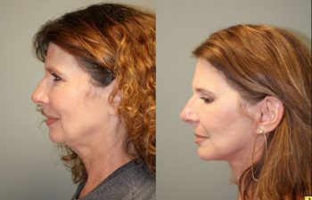 S-Lift Facelift and Lower Blepharoplasty - 57 year old female desiring correction of aging neck and jaw line. She underwent S-Lift (extended SMAS Facelift) procedure 2 months previously.