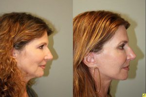 S-Lift Facelift and Lower Blepharoplasty - - 57 year old female desiring correction of aging neck and jaw line. She underwent S-Lift (extended SMAS Facelift) procedure 2 months previously.