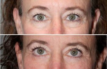 Eyelid blepharoplasty (eyelid lifts) - 59 year old female 6 months following and upper and lower eyelid blepharoplasty (eyelid lifts).