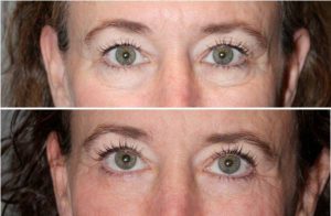 Before & After Eyelid blepharoplasty (eyelid lifts) - 59 year old female 6 months following and upper and lower eyelid blepharoplasty (eyelid lifts).