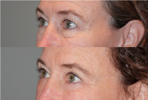 Before & After Eyelid blepharoplasty (eyelid lifts) - 59 year old female 6 months following and upper and lower eyelid blepharoplasty (eyelid lifts).