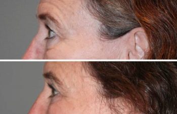 Eyelid blepharoplasty (eyelid lifts) - 59 year old female 6 months following and upper and lower eyelid blepharoplasty (eyelid lifts).