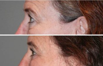 Eyelid blepharoplasty (eyelid lifts) -