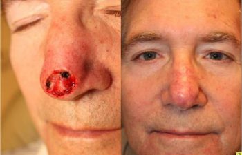 Skin Cancer Reconstruction - 3 months following skin cancer reconstruction using a bilobed flap closure.