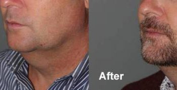43 year old male one month after 2nd treatment
