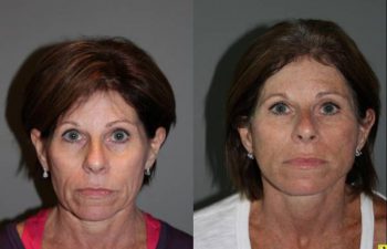 KalosLift Facelift and revision upper Blepharoplasty - 56 Year old Female 3 months postop from a revision Upper Blepharoplasty and KalosLift, or extended mini deep plane facelift.