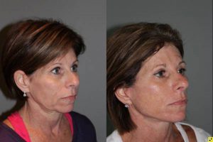 KalosLift Facelift and revision upper Blepharoplasty - 56 Year old Female 3 months postop from a revision Upper Blepharoplasty and KalosLift, or extended mini deep plane facelift.