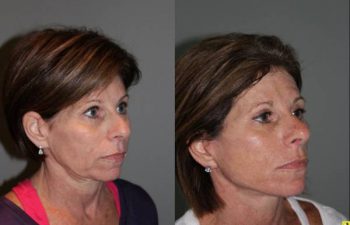 KalosLift Facelift and revision upper Blepharoplasty - 56 Year old Female 3 months postop from a revision Upper Blepharoplasty and KalosLift, or extended mini deep plane facelift.