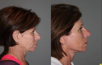KalosLift Facelift and revision upper Blepharoplasty - 56 Year old Female 3 months postop from a revision Upper Blepharoplasty and KalosLift, or extended mini deep plane facelift.