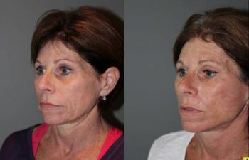KalosLift Facelift and revision upper Blepharoplasty - 56 Year old Female 3 months postop from a revision Upper Blepharoplasty and KalosLift, or extended mini deep plane facelift.