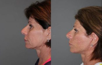 KalosLift Facelift and revision upper Blepharoplasty - 56 Year old Female 3 months postop from a revision Upper Blepharoplasty and KalosLift, or extended mini deep plane facelift.