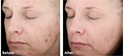 Before and After photo of a womans face after using Skin Medica Vitalize Peel