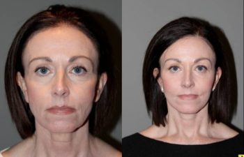 S-Lift Facelift and Lower Blepharoplasty - Correction of aging neck, jaw line and lower eyelids. - 49 year old female desiring correction of her aging neck and jaw line and the bags/puffiness under her eyes. She underwent S-Lift facelift and lower eyelid blepharoplasty with fat transposition 4 months previously.