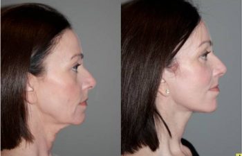S-Lift Facelift and Lower Blepharoplasty - Correction of aging neck, jaw line and lower eyelids. - 49 year old female desiring correction of her aging neck and jaw line and the bags/puffiness under her eyes. She underwent S-Lift facelift and lower eyelid blepharoplasty with fat transposition 4 months previously.
