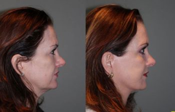 Mini Deep Plane Facelift & Upper and Lower Eyelid Blepharoplasty - 52 year old female 1 year post-op from upper and lower eyelid blepharoplasty and mini deep plane facelift​​.