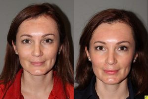 Pearl Laser Skin Resurfacing - 38 year old female 1 week post op from a Pearl Laser Skin Resurfacing procedure to reduce moderate wrinkles and brown pigmentation..