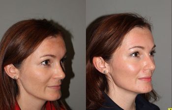 Pearl Laser Skin Resurfacing - 38 year old female 1 week post op from a Pearl Laser Skin Resurfacing procedure to reduce moderate wrinkles and brown pigmentation.