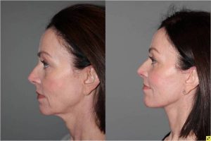 S-Lift Facelift and Lower Blepharoplasty - Correction of aging neck and jaw line. 49 year old female desiring correction of her aging neck and jaw line and the bags/puffiness under her eyes. She underwent S-Lift facelift and lower eyelid blepharoplasty with fat transposition 4 months previously.