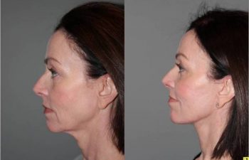 S-Lift Facelift and Lower Blepharoplasty - Correction of aging neck and jaw line. 49 year old female desiring correction of her aging neck and jaw line and the bags/puffiness under her eyes. She underwent S-Lift facelift and lower eyelid blepharoplasty with fat transposition 4 months previously.