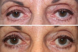 Upper eyelid ptosis repair - 68 year old female 5 months following a bilateral upper eyelid ptosis repair to raise the position of the upper eyelid, creating a more vibrant, youthful appearance to the eyes.
