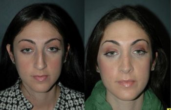 Cosmetic Rhinoplasty - Cosmetic Rhinoplasty performed on 27yo female for bridge/hump reduction and tip refinement.