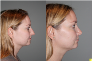 Cosmetic Rhinoplasty - Cosmetic Rhinoplasty performed on 29yo female for bridge/hump reduction and tip refinement.