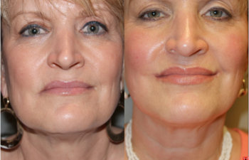 Corner Mouth Lip Lift - 55 year old female under went a corner of mouth lip lift to correct the drooping that occurs with age and create a youthful, attractive, upturn at the corners of the mouth.
