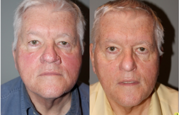 Rhinophyma Treatment - 71 year old male with Rhinophyma 6 months following electrocautery loop excision.