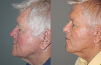 Rhinophyma Treatment - 71 year old male with Rhinophyma 6 months following electrocautery loop excision.