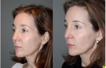 Blepoharoplasty/Rhinoplasty - 52 yo female s/p upper blepoharoplasty, lower blepharoplasty with fat transposition, and a rhinoplasty to refine tip and narrow bridge. Patient requested subtle results and not to alter height of the bridge of her nose.