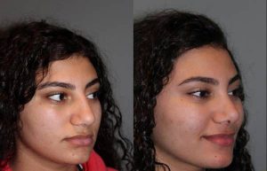 Cosmetic Rhinoplasty - 17 year old female 4.5 months post op from a cosmetic rhinoplasty