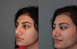 Cosmetic Rhinoplasty - 17 year old female 4.5 months post op from a cosmetic rhinoplasty