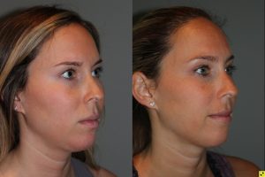 25 year old female 4 months post injection for Kybella double chin treatment