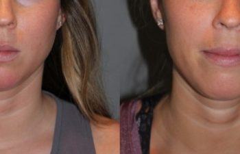 25 year old female 4 months post injection for Kybella double chin treatment