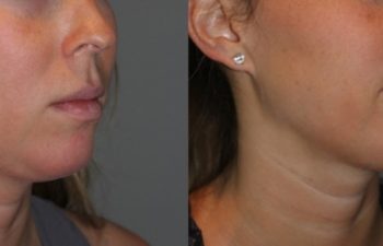 25 year old female 4 months post injection for Kybella double chin treatment