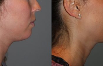 25 year old female 4 months post injection for Kybella double chin treatment