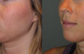 25 year old female 4 months post injection for Kybella double chin treatment