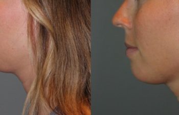 25 year old female 4 months post injection for Kybella double chin treatment