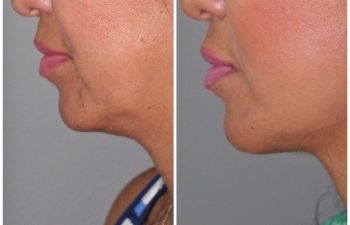 51 year old female 1 year post op following a revision lower eyelid blepharoplasty and a kaloslift mini deep plane facelift.