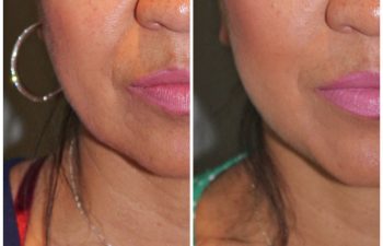 51 year old female 1 year post op following a revision lower eyelid blepharoplasty and a kaloslift mini deep plane facelift.