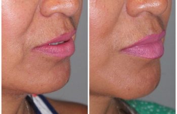 51 year old female 1 year post op following a revision lower eyelid blepharoplasty and a kaloslift mini deep plane facelift.