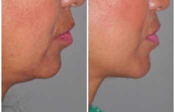 51 year old female 1 year post op following a revision lower eyelid blepharoplasty and a kaloslift mini deep plane facelift.