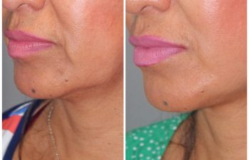 51 year old female 1 year post op following a revision lower eyelid blepharoplasty and a kaloslift mini deep plane facelift.