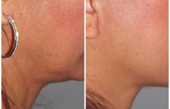 51 year old female 1 year post op following a revision lower eyelid blepharoplasty and a kaloslift mini deep plane facelift.