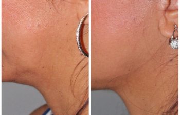 51 year old female 1 year post op following a revision lower eyelid blepharoplasty and a kaloslift mini deep plane facelift.