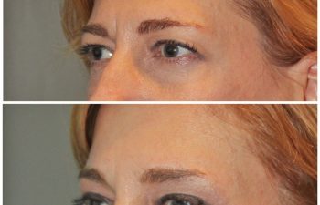50 year old female 1 month following an endoscopic brow lift and upper eyelid blepharoplasty.
