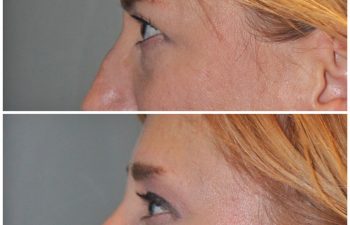 50 year old female 1 month following an endoscopic brow lift and upper eyelid blepharoplasty.
