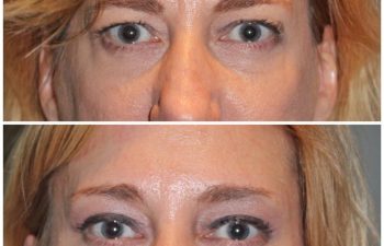 50 year old female 1 month following an endoscopic brow lift and upper eyelid blepharoplasty.