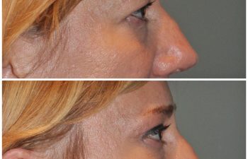 50 year old female 1 month following an endoscopic brow lift and upper eyelid blepharoplasty.